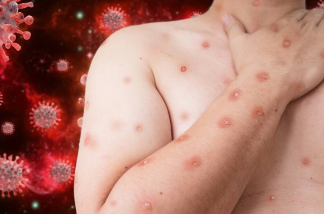 அபுதாபியில் இருந்து திருவனந்தபுரம் திரும்பிய இளைஞருக்கு குரங்கம்மைநோய் தொற்று!