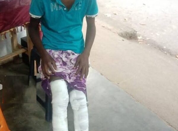 சிங்களப் பாடசாலை ஒன்றில் தமிழ் மாணவனின் காலகளை எரித்த காவாலி மாணவர்கள்